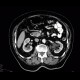 Tumour of pancreatic head: CT - Computed tomography